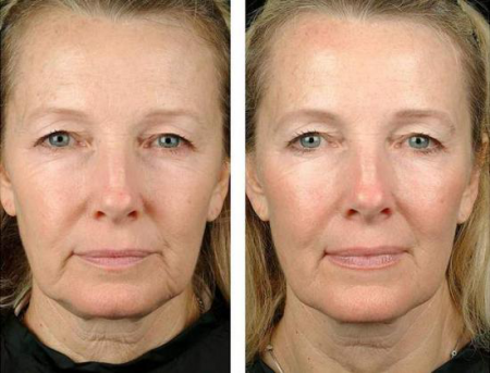 Szálak face-lift van