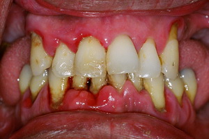 A periodontitis tünetei, okai és paradentózisnál hazai népi jogorvoslati otthon