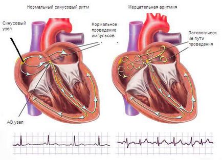 Megszakítások a szív - okai, tünetei és kezelése