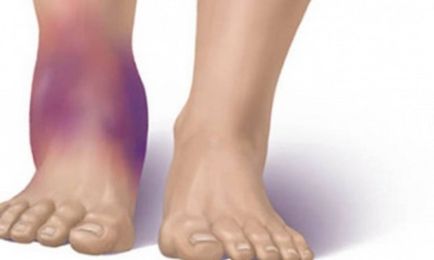 Törés láb, mit kell tennie, tünetei és kezelése