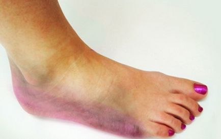 Törés láb, mit kell tennie, tünetei és kezelése
