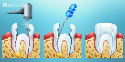 periodontitis kezelésében