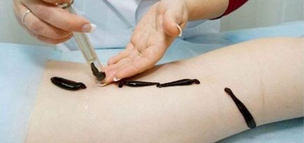 Piócák - előnyök és ártalmak kezelésére válaszok (kezelés) Piócák - előnyök és ártalmak kezelésére vélemények
