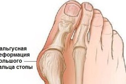 Plano-valgus lábát egy gyerek okoz és kezelés (oka) Plano-valgus lábát egy gyerek okozza és a kezelés