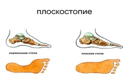 Plano-valgus lábát egy gyerek okoz és kezelés (oka) Plano-valgus lábát egy gyerek okozza és a kezelés