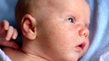 Miért van az allergia csecsemők, tünetek, kezelési módszerek és a megelőzés