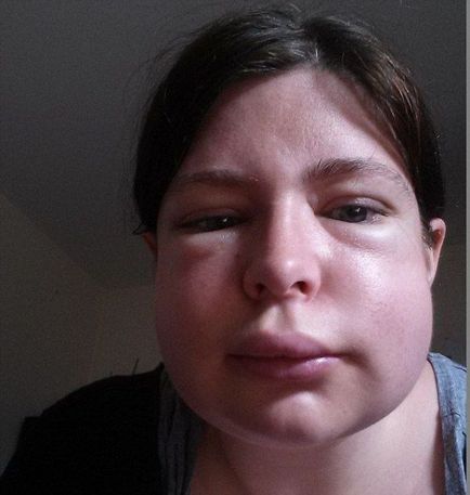 megnyilvánulása allergia ananász - szerencse (allergia) megnyilvánulása allergia ananász - egészséges