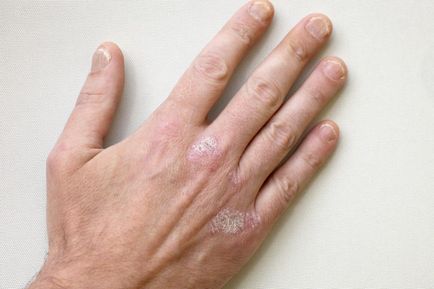Psoriasis a kezében a fotó, a tünetek és a hatékony kezelés kenőcsök