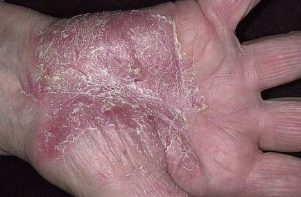 Psoriasis kézen kezdeti szakaszában - a pikkelysömör a kezét kezelés