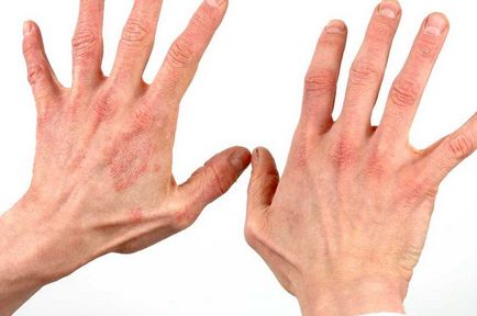 Psoriasis kézen kezdeti szakaszában - a pikkelysömör a kezét kezelés