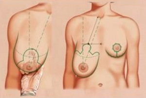 Reduction mammoplasty indikációk, ellenjavallatok (jelzések) Reduction mammoplasty javallatok, ellenjavallatok
