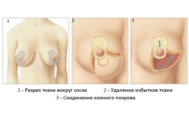 Reduction mammoplasty javallatok, ellenjavallatok (mammoplasty) Reduction mammoplasty javallatok, ellenjavallatok