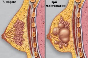 Reduction mammoplasty javallatok, ellenjavallatok