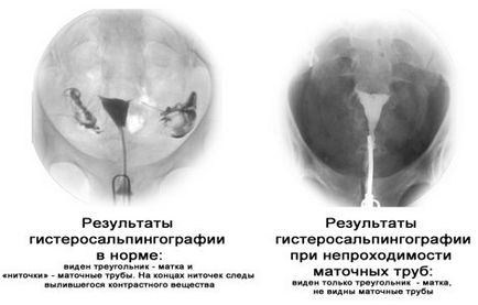 X-ray a petevezeték potenciális következmények, mint ahogy a (következmények) X-ray a petevezeték potenciális következmények, akárcsak