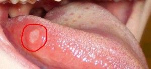 Stomatitis okoz, mitől és miért jelenik meg (előfordulás) Stomatitis okoz, mitől és miért tűnik