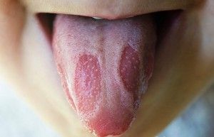 Stomatitis okoz, mitől és miért tűnik