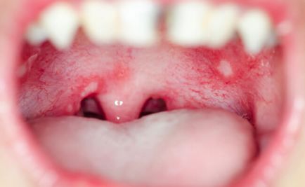 Stomatitis tünetek, okok, kezelésére szájpenész felnőtteknél (ok) Stomatitis tünetei, okai, kezelése szájpenész felnőtteknél