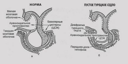 Ephippium az agyban (török) ephippium agy