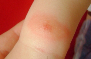 Bögöly harapás tünetei, kezelése (horsefly harapás fotó tünetek, amelyek a kezelés hatásainak megszüntetése ödéma mint kend tumor hogyan védhetik meg magukat) Bögöly harapás tünetei, kezelése