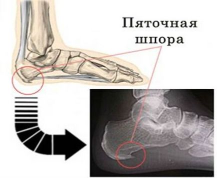 Ultrahang hidrokortizon egy sarok homlok