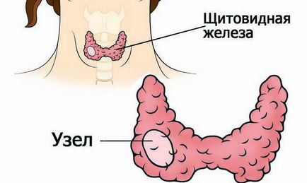 A csomópontok a pajzsmirigyben nők tünetei és kezelése, azaz milyen következményekkel