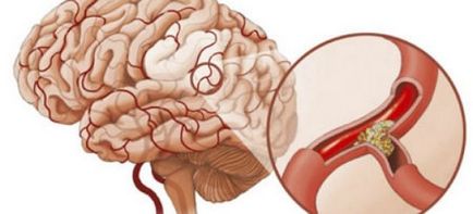 A cerebrovaszkuláris vasospasmus tünetek és a kezelés