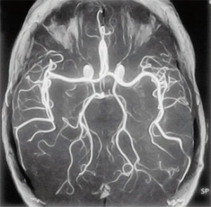 A cerebrovaszkuláris vasospasmus (agyi) tünetek, kezelés, megelőzés