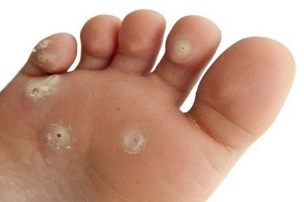 Vírus papillomatosis (autizmus autizmus gyermek) vírus papillomatosis