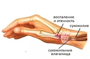 Az inak gyulladása (styloiditis) a kéz tünetek és kezelés
