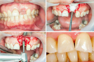 Visszaállítása törött elülső foga