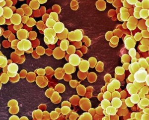 Staphylococcus aureus a kezelt felnőtt fotó fertőzések, hatékony rendszerek és kezelési módszerek