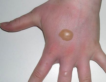 Burn kezelés medvetalp Burn kezelés medvetalp