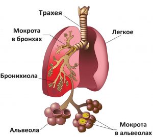 Mi pangásos tüdőgyulladás Mi pangásos tüdőgyulladás
