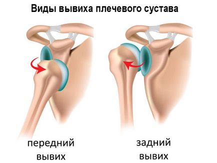 Hogyan lehet csökkenteni a váll Hogyan lehet csökkenteni a váll