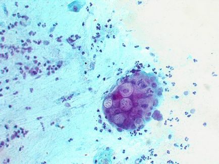 Chlamydia és a terhesség kezelés Chlamydia és a terhesség kezelés
