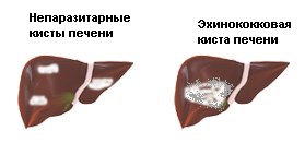 hydatid betegség diagnózisa hydatid betegség diagnózisa