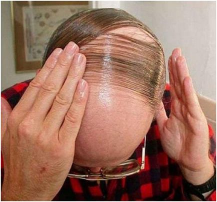 5 ok megjelenése kopasz foltok a homlok és a férfiak 2 módon kell kezelni őket - haircutmen