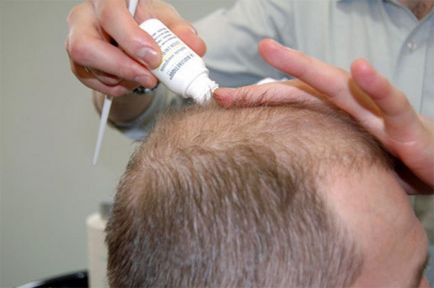 5 ok megjelenése kopasz foltok a homlok és a férfiak 2 módon kell kezelni őket - haircutmen (oka) 5 ok megjelenése kopasz foltok a homlok és a férfiak 2 módon kell kezelni őket - haircutmen