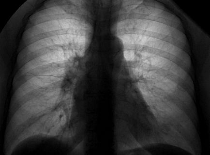 Adenocarcinoma a tüdő tünetek, színpadi és prognózis az élet