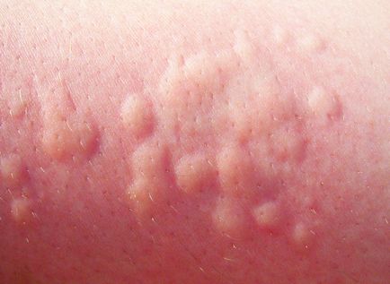 Allergiás urticaria hogyan kell kezelni