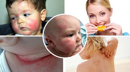 Allergiás a narancs - tünetek és a kezelés gyermekek és felnőttek részére