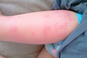 Allergia az édes gyermekek és felnőttek fotó tünetek