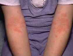 Allergia az édes gyermekek és felnőttek fotó tünetek