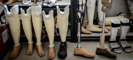 láb amputáció rehabilitáció lehetséges hatásai