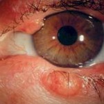 Blepharoconjunctivitis okai, tünetei, kezelések