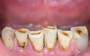 A öblítse ki a száját a műtét után, hogy távolítsa el a fogat
