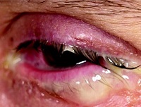 Mi a teendő, ha a kivörösödött szemmel és fájó, hogyan kell eltávolítani bőrpír