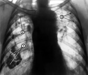 Mi ez - mellhártya rétegek röntgenfelvételen a tüdőben, és úgy néz ki, mint egy egészséges tüdő