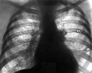 Mi ez - mellhártya rétegek röntgenfelvételen a tüdőben, és úgy néz ki, mint egy egészséges tüdő