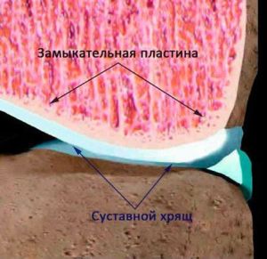 Mi van a porc melletti szklerózis, az ízületi felületek és a véglapok a csigolyatestek